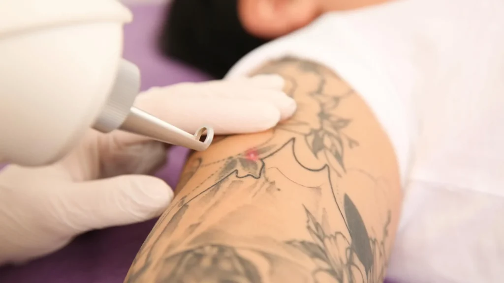 Trabzon tattoo removal