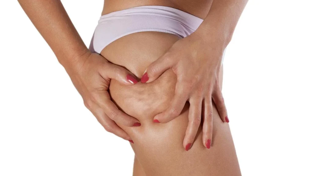 Is Cellulite Treatment Possible?